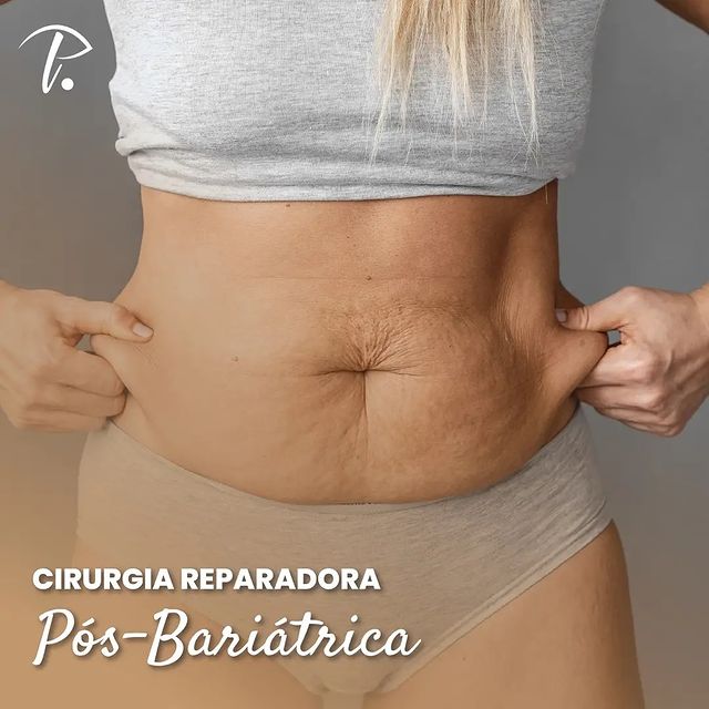 Cirurgia reparadora pós bariátrica Dra Priscilla Lotierzo